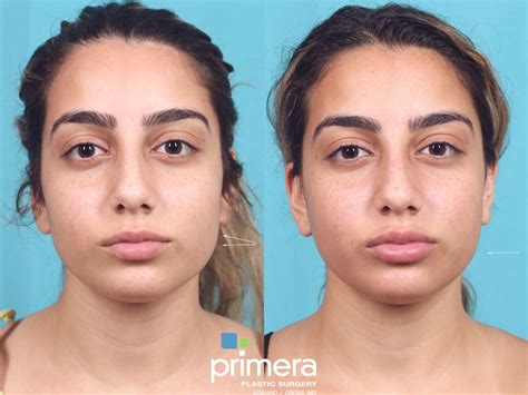 BOTOX® Cosmetic Before and After Pictures Case 743 | Orlando, Florida | Primera Plastic Surgery