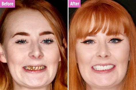 Woman, 26, whose yellow and rotten teeth were so bad she was told she’d ...