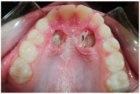 What Causes Impacted Canines