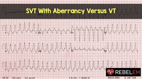 supraventricular tachycardia with aberrancy. - Google Search in 2021