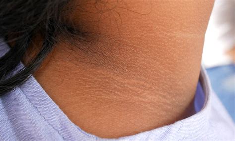 Acanthosis Nigricans: Home Remedies for Velvety Dark Neck