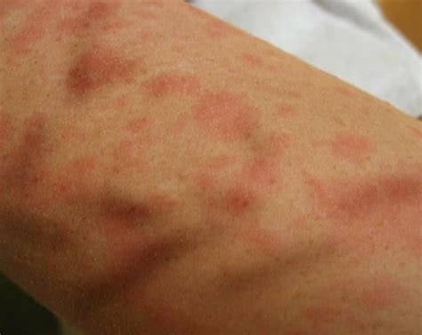 Red Itchy Bumps On Skin Causes Symptoms Pictures Trea - vrogue.co