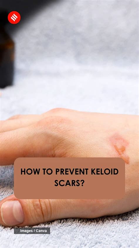 How to prevent Keloid scars? | The Indian Express