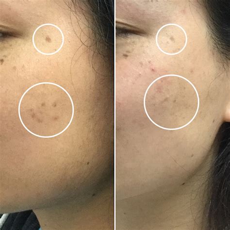 Mole Removal | Usha Rajagopal, MD