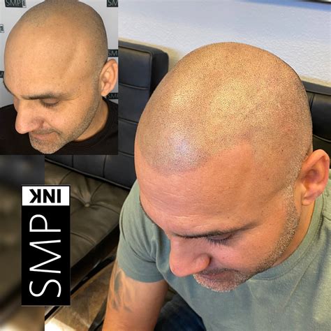 Scalp Micropigmentation Before and After Photos - SMP INK