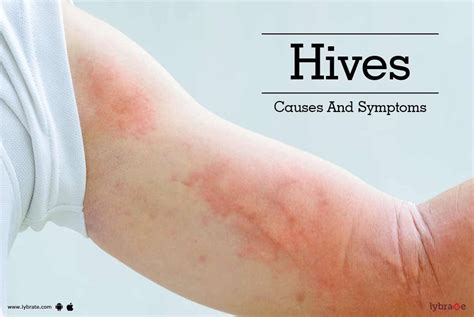 Sun Hives Causes Symptoms And Cures Of Sun Hives - vrogue.co