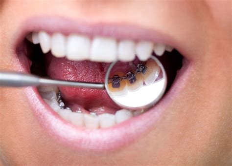 Lingual Braces Instructions - Yang Orthodontics