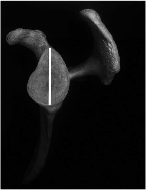 Length of the glenoid cavity measurement as described in Table 1. | Download Scientific Diagram