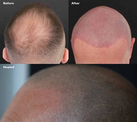 Hair Transplant Scar Types and How To Hide Them – AZPMU