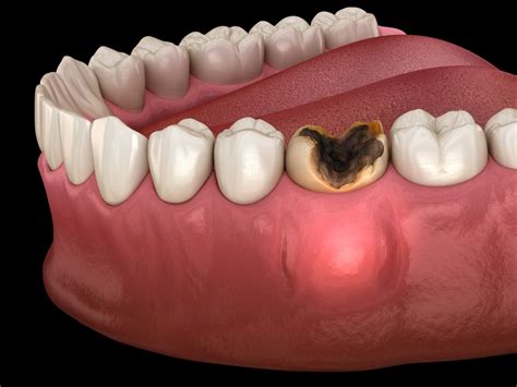Dental Infection Symptoms