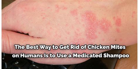 How to Get Rid of Chicken Mites in Your House | 10 Effective Steps (2024)