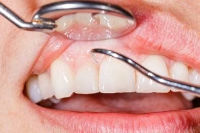 Gum Disease Surgery Types and Cost | UtoDent.com