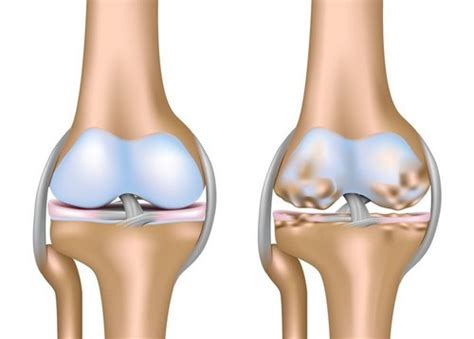 Treatment of arthrosis, knee joints - Medical diagnosis