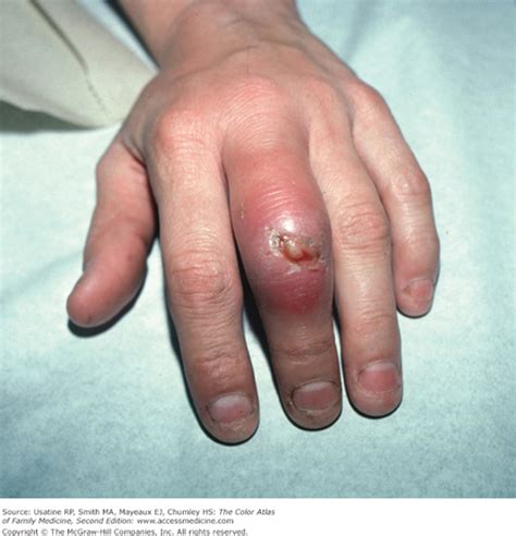 Cellulitis | AccessMedicine Network