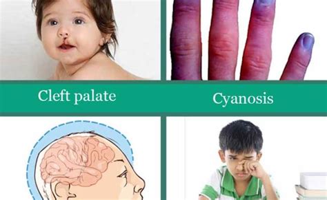 Digeorge Syndrome Causes Picture Symptoms And Treatment – Otosection