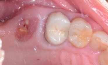 Pictures of Granulation Tissue After Tooth Extraction: Pictures and ...