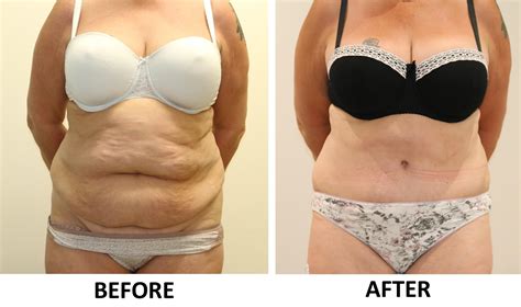 Tummy Tuck (Abdominoplasty) - The Karri Clinic