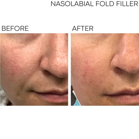 BEFOREAFTER NASOLABIAL FOLDS JUVEDERM Kathryn Tschanz - Dermatology Affiliates