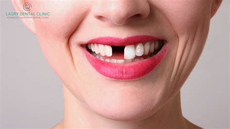 Missing a Front Tooth? Here are 3 Ways You Can Feel Confident