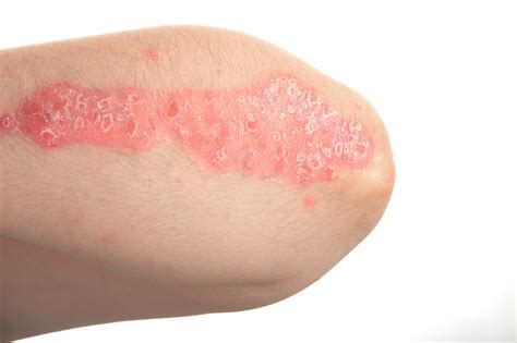 Psoriasis Skin Rash On Face