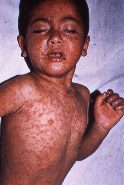 Measles Rash Face