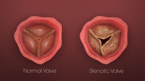 Transcatheter Heart Valves: How they revolutionized heart surgeries