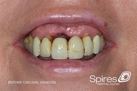 Gingival Veneers Case Study- Lichfield Dentist