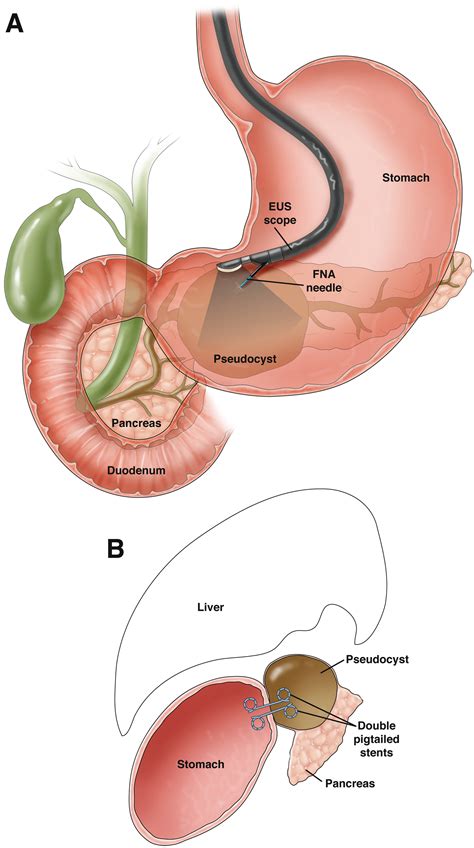 Evidence-Based Treatment of Pancreatic Pseudocysts - Gastroenterology