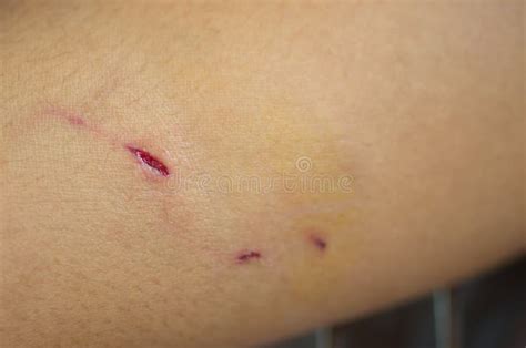 Dog bited wound. stock photo. Image of hospital, hurt - 123614202