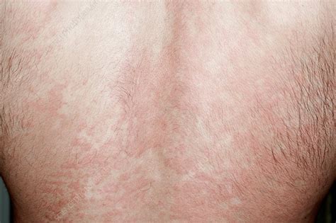 Urticaria Rash Causes