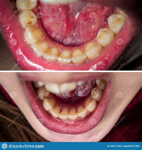 Before and after of Removing Tartar. Teeth after Hygienic Cleaning Stock Image - Image of ...