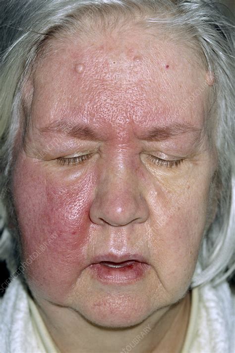 Cellulitis infection - Stock Image - M130/0668 - Science Photo Library