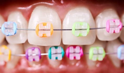 Orthodontics Rubber Bands Stock Photos Free Royalty-Free Stock Photos ...