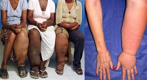 Elephantiasis Symptoms