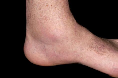 What Are The Symptoms Of Gout In The Ankle - GoutInfoClub.com