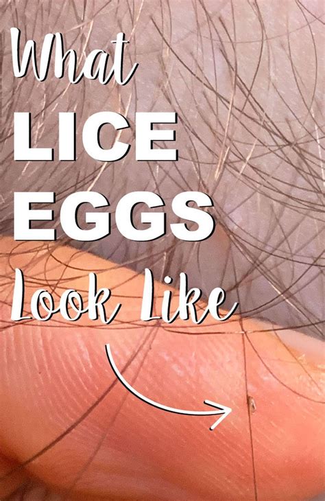 What Lice Eggs Look Like - 9 Simple Tricks to Spot Nits | Lice eggs, Louse, Head louse