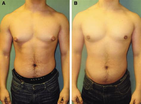 Gynecomastia Liposuction Surgery