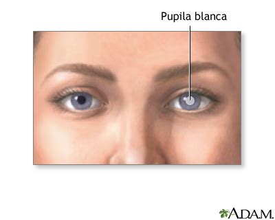 Pupila blanca: MedlinePlus enciclopedia médica illustración