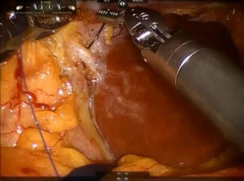 Robotic Resection of the Liver Caudate Lobe: Technical Description and Initial Consideration ...