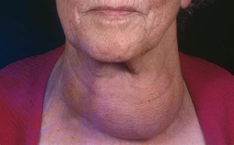 example of a goiter Diagram | Quizlet