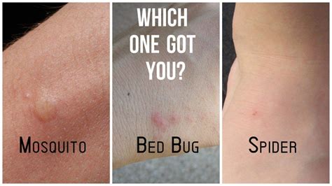 Mosquito Bite Bed Bug Bite Difference