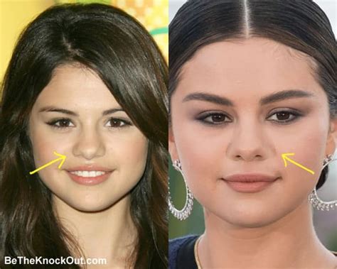 Did Selena Gomez Get A Nose Job - LacoulEuRetleauBe