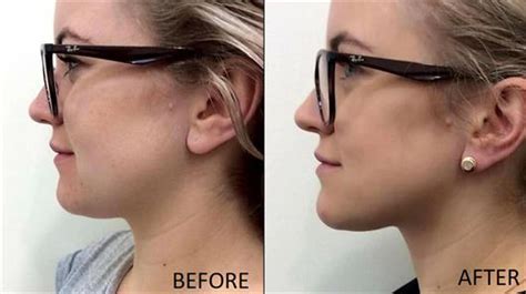 Get Rid Of Neck Fat Double Chin - change comin