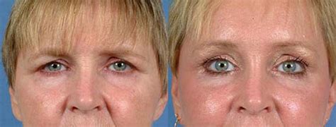 Brow/Forehead Lift Before & After Photos Patient 73 | Louisville & Lexington, KY ...