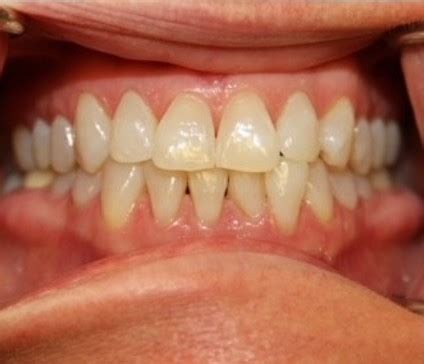 Before & After Dental Photos Boston | Dental Implants Before and After ...