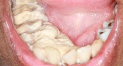 Troubleshooter: Extremely heavy tartar coding | Dentistry IQ