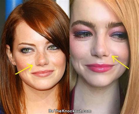 Emma Stone Plastic Surgery Comparison Photos