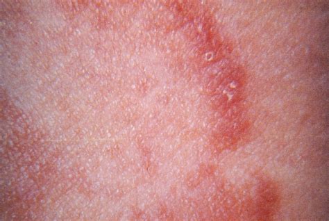 Fungal Skin Infection Of Many Colors Tinea Versicolor Pathogenesis ...