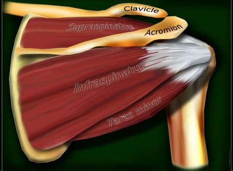 SUPRAspinatus Rotator Cuff Treatment - The Pain-FREE Shoulder Clinic ...