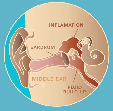 What a Middle Ear Infection Looks Like - PhotoniCare